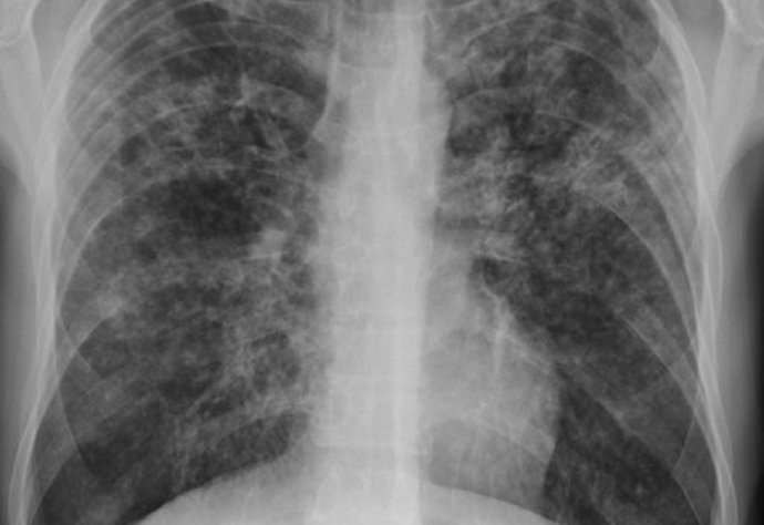 A patient with TB credit James Heilman, MD