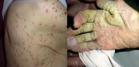 Scabies presentations from our UK care home study (Cassell et al, Lancet Infectious Diseases, 2018) Scabies presentations from our UK care home study (Cassell et al, Lancet Infectious Diseases, 2018)
