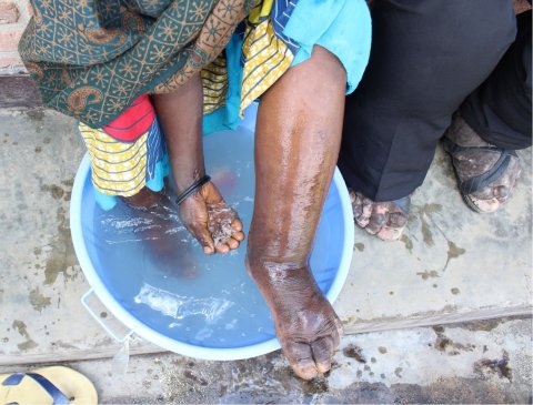 © Kebede Deribe A woman in Rwanda with elephantiasis washes her legs as part of the WHO-recommended morbidity management and disability prevention for podoconiosis and lymphatic filariasis. © Kebede Deribe A woman in Rwanda with elephantiasis washes her legs as part of the WHO-recommended morbidity management and disability prevention for podoconiosis and lymphatic filariasis.