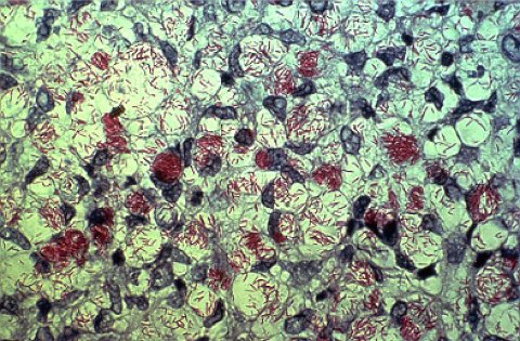 M. leprae appears red when a Ziehl-Neelsen stain is used M. leprae appears red when a Ziehl-Neelsen stain is used