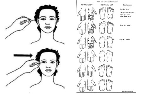 The corneal sensation test (left) and palm and soles nerve function record (right) line drawings by Jean Watson (Essential Action to Minimize Disability in Leprosy Patients, Jean M Watson, second edition,1994)