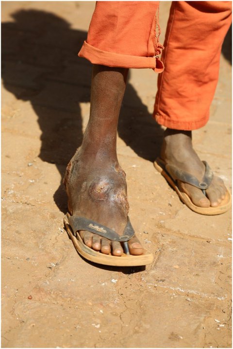 Mycetoma affects the foot of a young boy Mycetoma affects the foot of a young boy