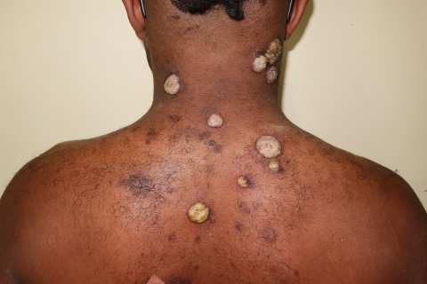 A yaws papilloma from a child living in a yaws endemic village in Papua New Guinea. These papilloma are often an early presentation of yaws and are teeming with bacteria. A yaws papilloma from a child living in a yaws endemic village in Papua New Guinea. These papilloma are often an early presentation of yaws and are teeming with bacteria.