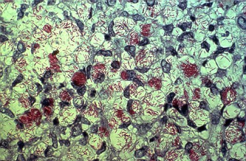 M. leprae appears red when a Ziehl-Neelsen stain is used