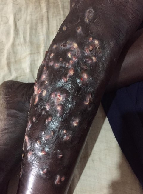 Mycetoma from Sudan Mycetoma from Sudan