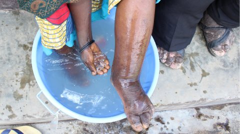 A woman with podoconiosis washes her foot. Photo: Dr Kebede Deribe