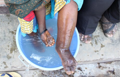 A woman with podoconiosis washes her foot. Photo: Dr Kebede Deribe A woman with podoconiosis washes her foot. Photo: Dr Kebede Deribe