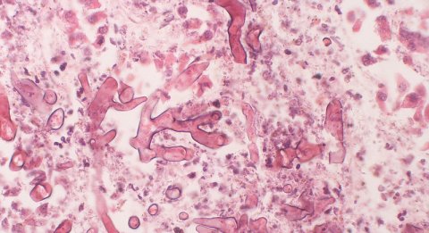 Mucormycosis: Large, irregular, non-septate hyphae; some with 90 degree angle branching | Photo: Yale Rosen / https://www.flickr.com/photos/pulmonary_pathology/5391502778/