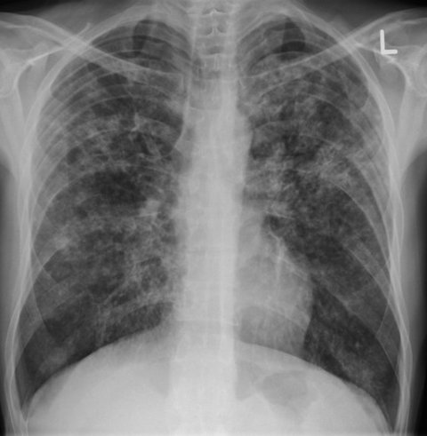 A patient with TB credit James Heilman, MD A patient with TB credit James Heilman, MD